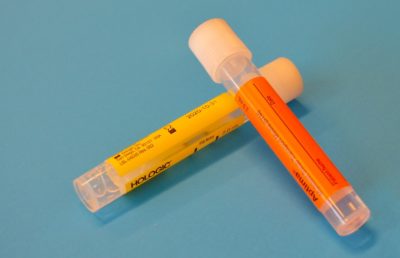 Urinalysis – Just How Important Is Checking The Urine?  VERY!!!